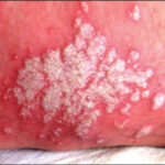 candidiasis