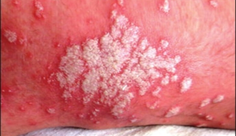 candidiasis