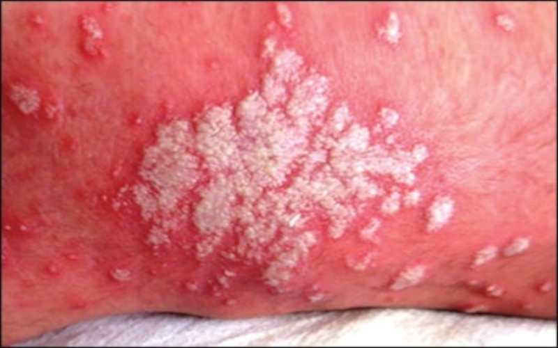 5 POINT ACTION PLAN AGAINST CANDIDIASIS